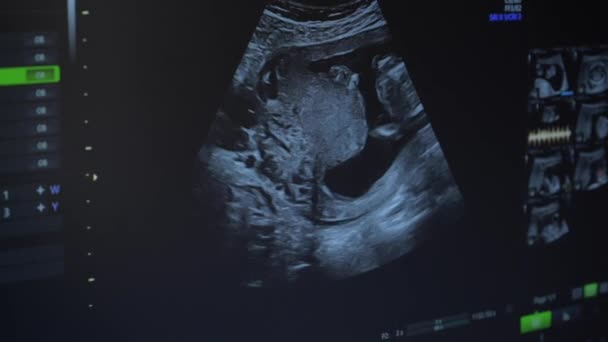 Ultrassom de mulher grávida — Vídeo de Stock