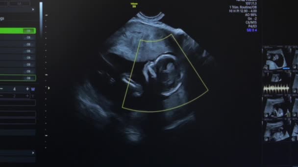 Ultrasuoni della donna incinta — Video Stock