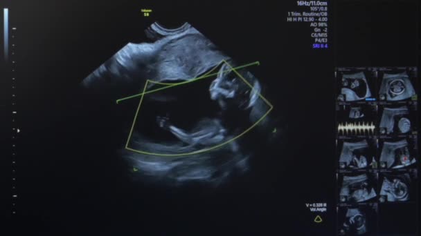 Echografie van zwangere vrouw — Stockvideo