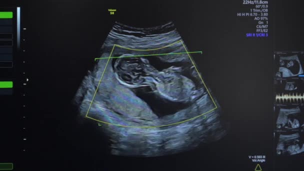 Ultrasound of pregnant woman — Stock Video