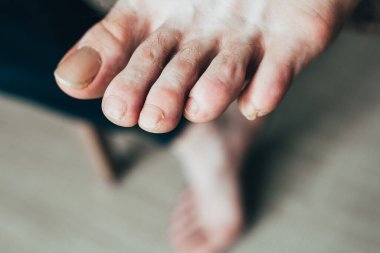 Erkek ayağında kırık, bakımsız tırnaklar. Hasar görmüş ve tırnaklarında çatlak var.