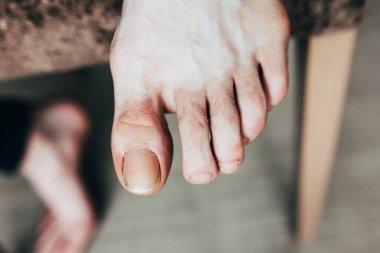 Erkekler tırnak tedaviden önce ayak pedikür 'ü - kişisel hijyen - kırık başparmak tırnağı