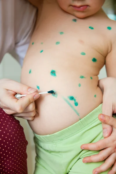 Varicela en niños — Foto de Stock