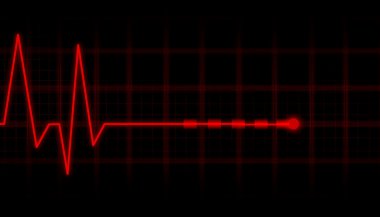 EKG Elektrokardiyogram