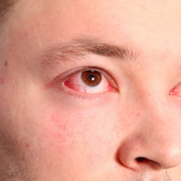 Mann mit Konjunktivitis Mann mit Konjunktivitis — Stockfoto