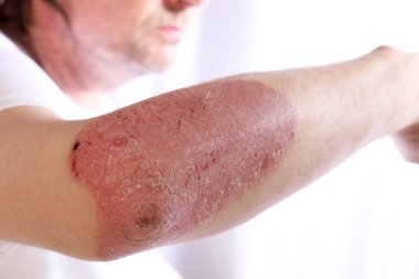 Person with plaque psoriasis of the arm clipart