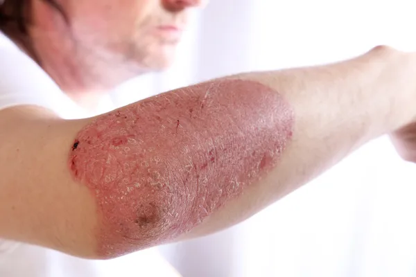 Person mit Plaque Psoriasis des Armes — Stockfoto