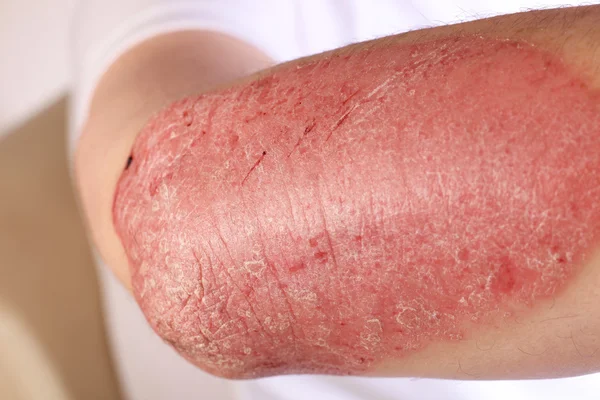 Psoriasis en plaques — Photo