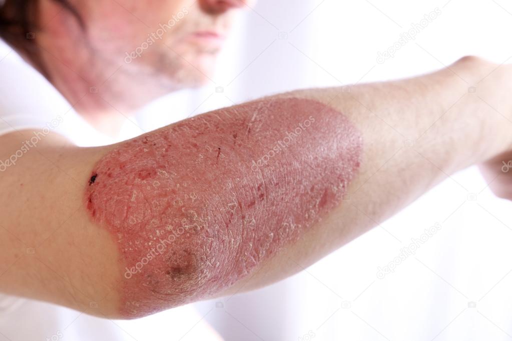 Person with plaque psoriasis of the arm