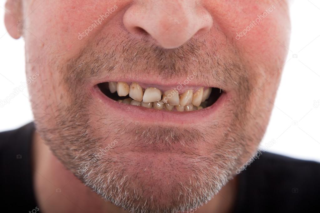 Close-up of a man's mouth showing teeth