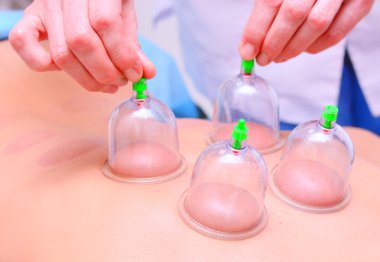 Cupping therapy, woman doctor removes cup from the patient's back clipart