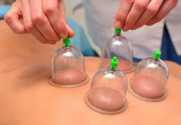 Terapia de ventosa, el médico de la mujer quita la taza de la espalda del paciente — Foto de Stock