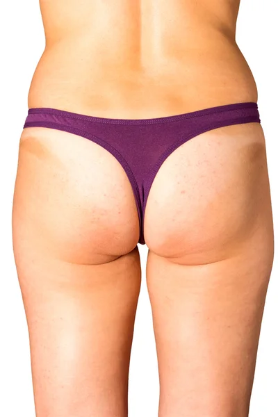 Cellulite and obesity — Stock Photo, Image
