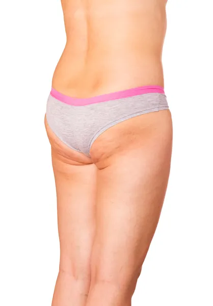 Skin with cellulite — Stock Photo, Image