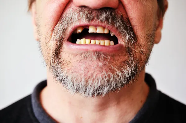 Faccia dell'uomo con una bocca sdentata aperta — Foto Stock