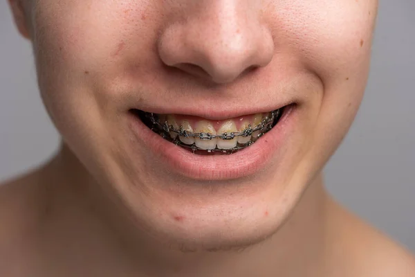 치과용 괄호를 사용하여 미소를 모습을 가까이 — 스톡 사진
