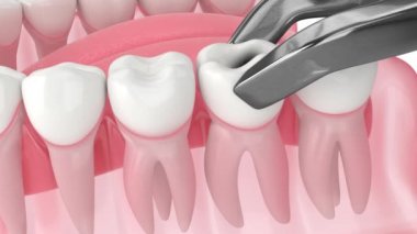 Diş çıkarma, uzay bakımı ve yeni diş büyüme sürecine sahip çene