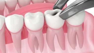 Diş büyütme sorunları, dişler arasındaki boşluğun sağlanamamasından kaynaklanıyor.