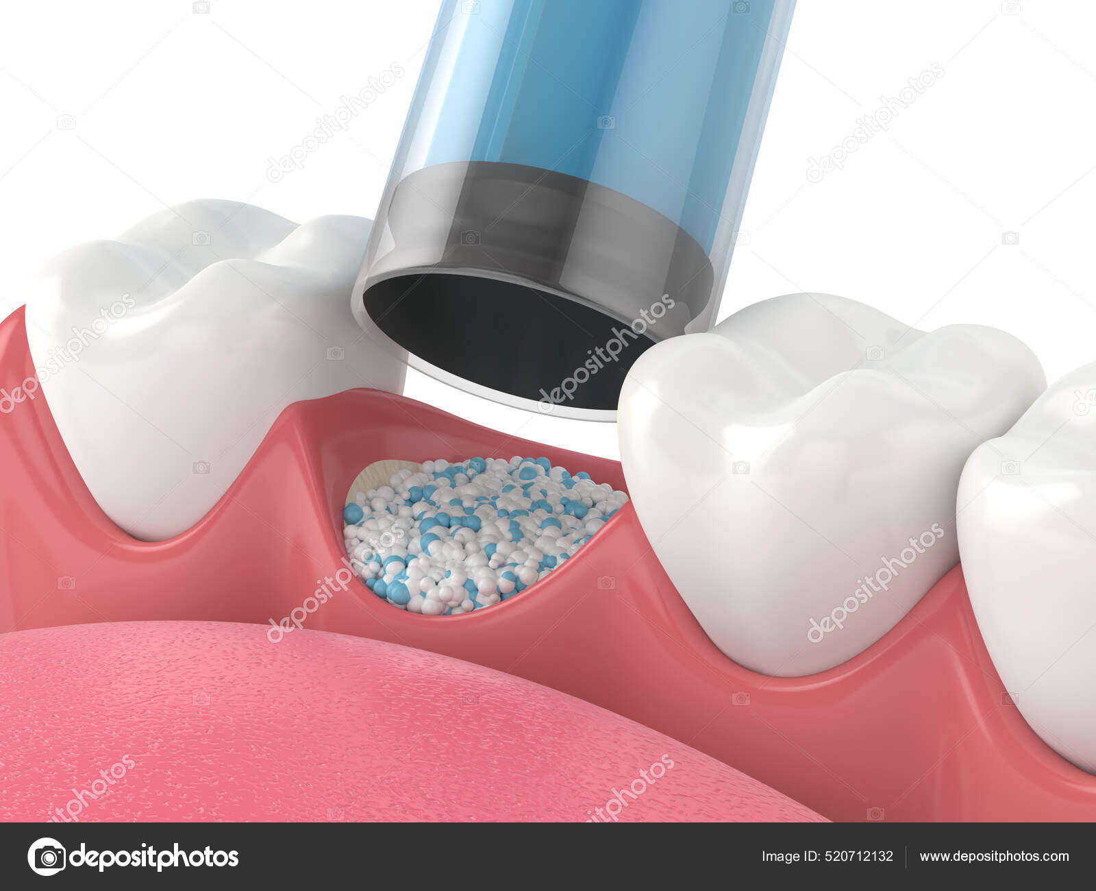 Render Dental Bone Grafting Dental Bone Biomaterial Application White Background Stock Photo by