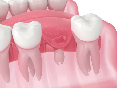 İki azı dişi arasında büyüyen yeni, kalıcı diş ile alt çenenin 3d görüntüsü
