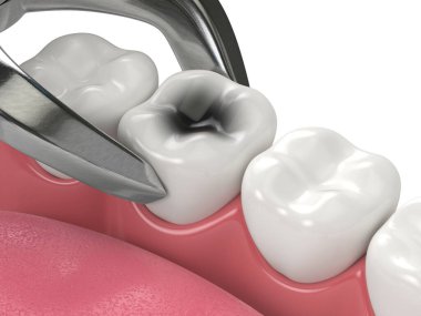 Diş kıskaçları tarafından çekilen alt çenenin 3d görüntüsü
