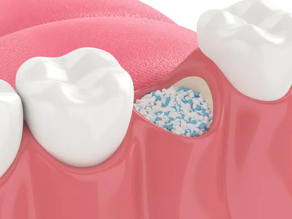 口腔内の歯骨生体材料で歯骨移植の3Dレンダリング 顎骨増強手順の概念 — ストック写真