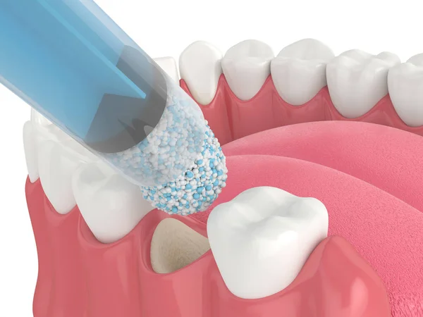 白い背景に歯科骨の生体材料のアプリケーションで歯骨移植の3Dレンダリング 顎骨増強手順の概念 — ストック写真