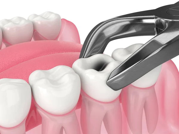 Renderelés Alsó Állkapocs Fogászati Csipesszel Kivont Foggal — Stock Fotó