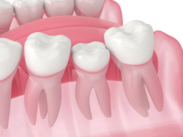 Renderizado Crecimiento Dental Bloqueado Por Dos Molares Adyacentes Concepto Dientes — Foto de Stock