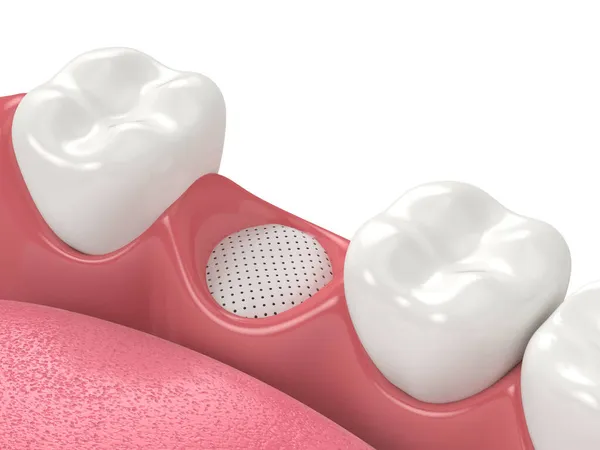 Rendu Greffe Dentaire Avec Membrane Sur Fond Blanc Concept Augmentation — Photo