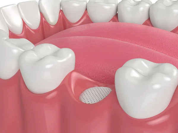 Rendering Dell Innesto Osseo Dentale Con Membrana — Foto Stock