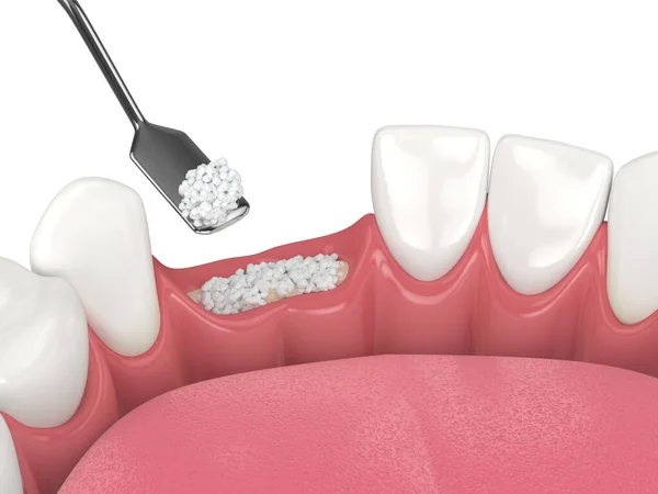 Візуалізація Зубної Кістки Біоматеріалом Стоматологічної Кістки Білому Тлі Концепція Процедури — стокове фото