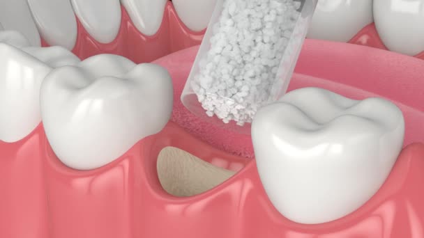 Injerto Hueso Dental Procedimiento Aumento Hueso — Vídeo de stock