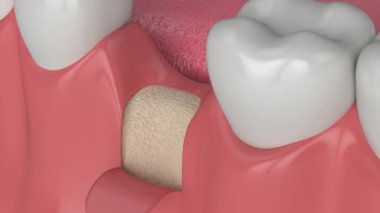 3D diş nakli ve kemik büyütme prosedürü.
