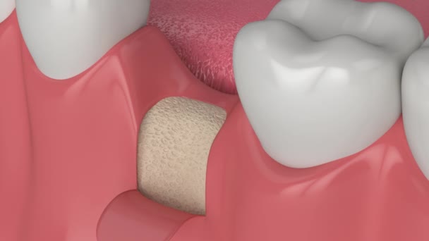 Οδοντοτεχνική Μεταμόσχευση Οστών Και Διαδικασία Αύξησης Των Οστών — Αρχείο Βίντεο