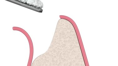 Diş implantı kurulumuna hazırlık olarak diş iliği nakli