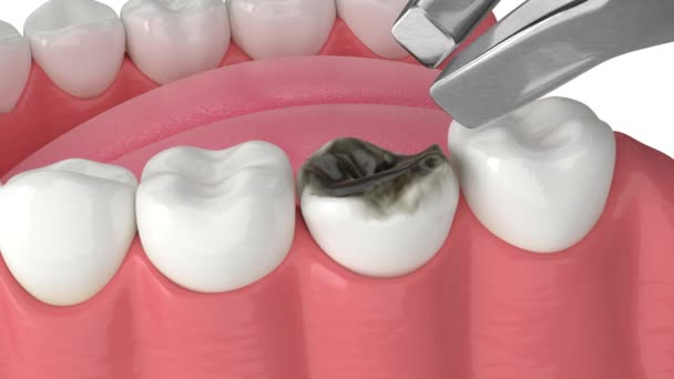 Enxertia Óssea Dentária Procedimento Aumento Ósseo — Vídeo de Stock