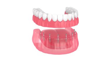 Tüm- on-8 çıkarılabilir, implantlar destekleniyor, takma dişler kurulumu