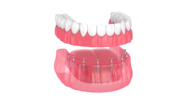 Tüm Çıkarılabilir Implantlar Destekleniyor Takma Dişler Kurulumu — Stok video