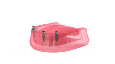 Çıkarılabilir takma dişler eklentisi, implantlar tarafından desteklenmektedir