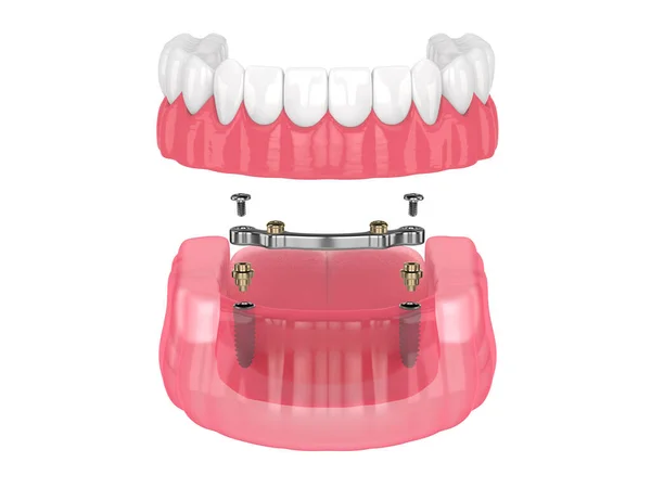 Bar Retained Removable Overdenture Installation Supported Implants White Backgroud — Stock Photo, Image