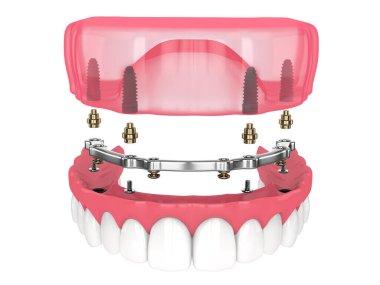 Beyaz arka plan üzerine implantlar tarafından desteklenen çıkarılabilir takma diş takma çubuğu