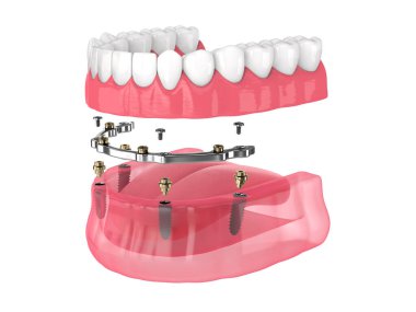 Beyaz arka plan üzerine implantlar tarafından desteklenen çıkarılabilir takma diş takma çubuğu