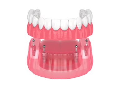 Tüm- on-4 çıkarılabilir, implantlar destekleniyor, beyaz arkaplan üzerine takma dişler kurulumu