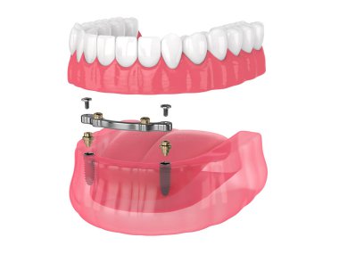 Beyaz arka plan üzerine implantlar tarafından desteklenen çıkarılabilir takma diş takma çubuğu