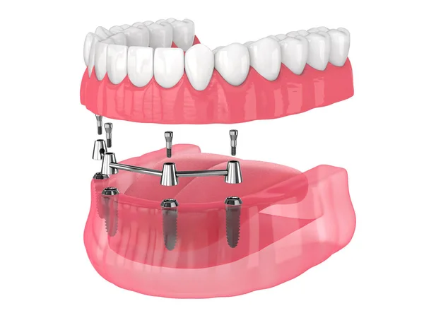 可摘除的假牙安装在棒夹附件上 由白色底座上的植入物支持 — 图库照片