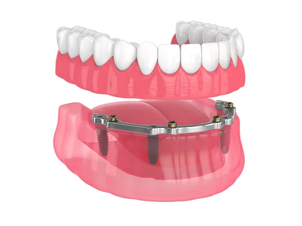 Beyaz Arka Plan Üzerine Implantlar Tarafından Desteklenen Çıkarılabilir Takma Diş — Stok fotoğraf