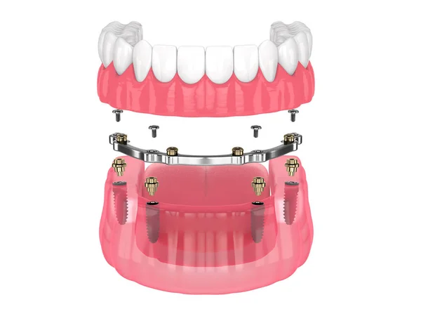 Riegel Beibehalten Herausnehmbare Prothese Installation Durch Implantate Über Weißem Hintergrund — Stockfoto