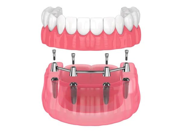 Çıkarılabilir Takma Diş Takma Eklentisi Beyaz Arkaplan Üzerine Implantlar Tarafından — Stok fotoğraf