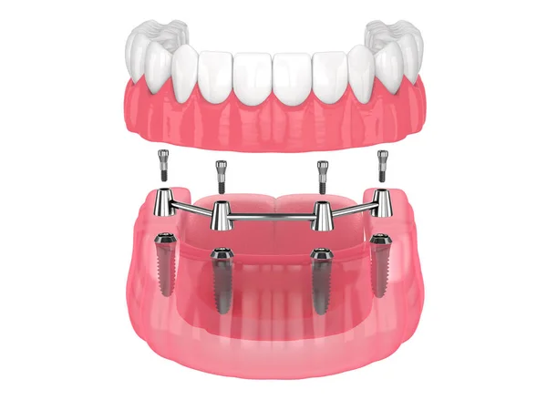 Instalação Overdenture Removível Fixação Clipe Barra Suportado Por Implantes Sobre — Fotografia de Stock